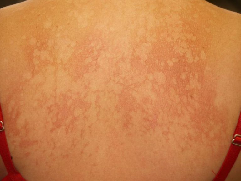 tinea versicolor back Tinea Versicolor